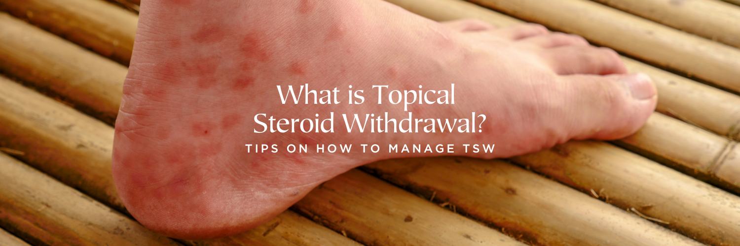 Cold Therapy for Topical Steroid Withdrawal